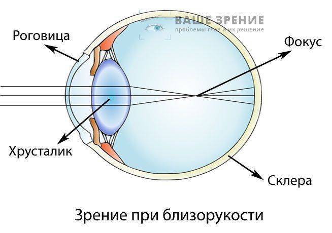 В цьому випадку краплі знижує прогресування хвороби, покращують стан очей, знімають зоровий спазм