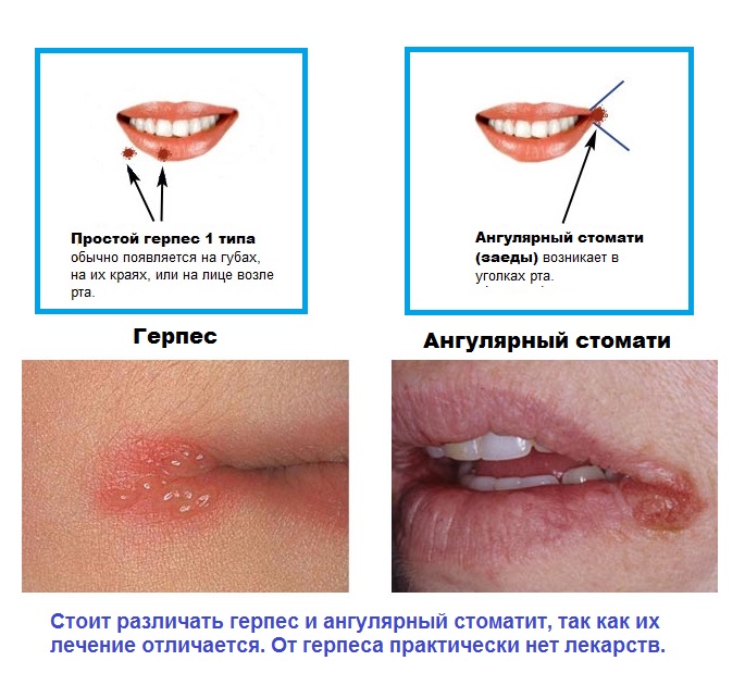 Дані дефекти виражаються негативним естетичним проявом, порушує мовні функції і призводить до загального дискомфорту хворого