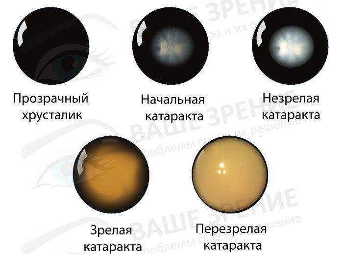 Залишається невеликий залишок ядра, а капсула накривається бляшки холестеринів