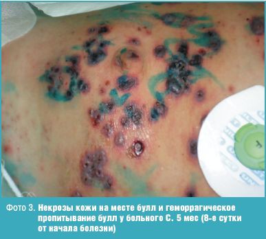 геморагічна вітрянка