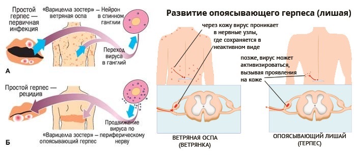 Традиційно вітряну віспу відносять до респіраторних захворювань, проте в носоглоткового слизу вірус з'являється лише в тих випадках, коли поверхня слизової оболонки також покривається висипаннями