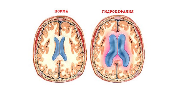 Придбана різновид захворювання проявляється переважно в перші місяці після народження