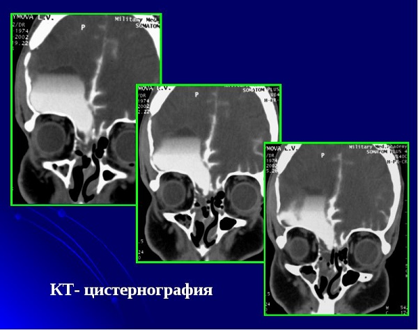 Її застосовують для визначення різновиду водянки