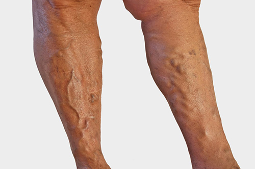 Мазі від варикозу глибоких вен на ногах можуть застосовуватися в складі комплексної терапії або в поєднанні з процедурами, які проводяться тільки в умовах стаціонару