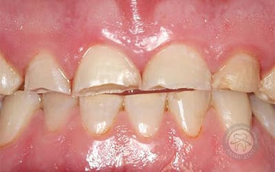Грубі порушення зубної форми до 40-50 років;   Зміна контуру і зовнішнього вигляду особи за рахунок руйнування зубів і гіпертрофії жувальної мускулатури;   Дисфункція скронево-нижньощелепного суглоба;   Лицьові болі невралгічного характеру