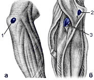 Ліктьовий суглоб   Гострий бурсит ліктьових сумок частіше є результатом механічного пошкодження і інфікування підшкірної ліктьовий сумки при її травмі
