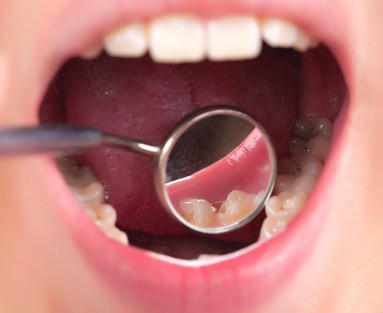 Професійне видалення зубного каменю - процедура, яка усуває затверділий шар відкладень з емалі зубів і в межзубном просторі