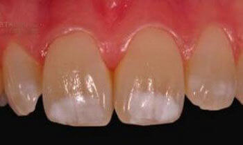 Основна причина тонкої, нерозвиненою емалі зубів при гіпоплазії - недолік мінералів
