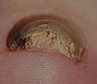 Навіть якщо вилікувати всі вогнища грибка на шкірі стоп або тулуба, то з зберігся вогнища інфекції в нігтях наступить повторне зараження