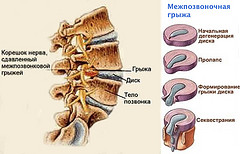 Міжхребцеві диски - це пружні освіти, які знаходяться між тілами кожної пари хребців і діють як амортизатори при різних навантаженнях на хребет