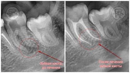 ЛІКУВАННЯ гранульоми зуба
