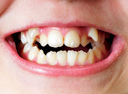 Більшість проблем з зубами і прикусом формується ще в дитячому віці