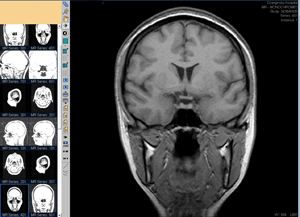 МРТ головного мозку - фронтальна   проекція