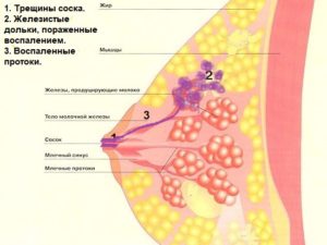 Щоб точніше визначити проблему, необхідно повністю зцідити груди, а через 3-4 години провести огляд