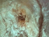 Під дією грибка з перебігом захворювання в нігті, всередині расслоенной нігтьової пластинки і в утворилися рогових нашаруваннях, утворюються порожнини, щілини, а іноді і канали, що проходять через весь ніготь