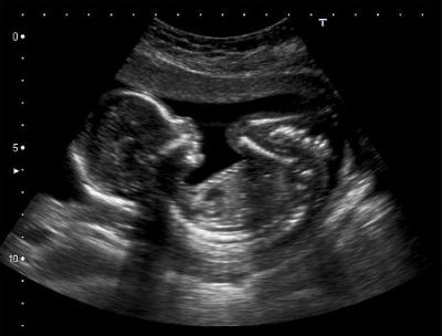 Знімки УЗД на 17-му тижні розвитку вагітності