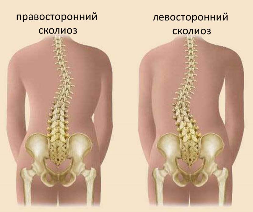 Сколіоз - це стійке бічне викривлення хребта