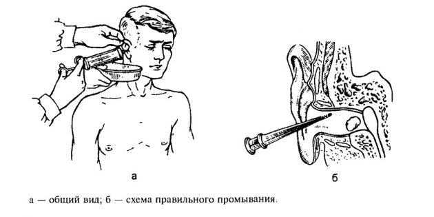 У вухо вводять шприц і по задній верхній стінці слухового проходу направляють струмінь води, яка і повинна вимити пробку