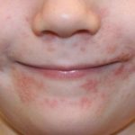 Висип біля рота у дитини червоного кольору може стати сигналом починається алергічної реакції