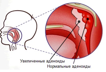 Розростання аденоїдів може також бути викликано алергією