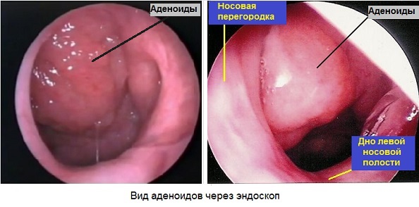 Є шанс побачити їх за допомогою спеціального дзеркальця, поміщеного в горло, але без наявної має медичної підготовки не варто мучити дитину