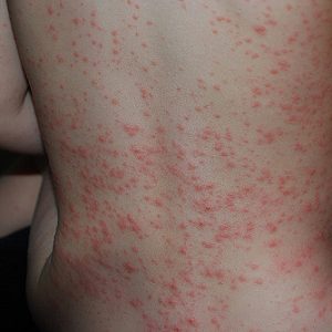 Навіть деякі досвідчені педіатри можуть сплутати розглядається захворювання з банальної алергією