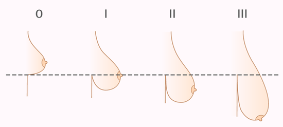 Птоз (мастоптоз) - це зміни форми і розміру молочних залоз в результаті розтягування шкіри, яка їх покриває