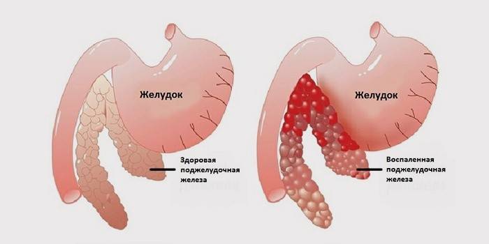 пронос;   блювота з домішкою жовчі;   сухість в ротовій порожнині;   відрижка, підвищене газоутворення;   підвищення температури;   зниження артеріального тиску;   пітливість;   задишка;   блідість шкірних покривів;   виражений наліт на мові;   втрата ваги