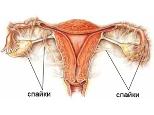 Спайковий процес в області придатків матки - призводить до перитонеального безпліддя, коли за рахунок спайок яйцеклітина з яєчника не може досягти труби і далі - порожнини матки