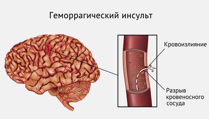 Що таке геморагічний інсульт головного мозку