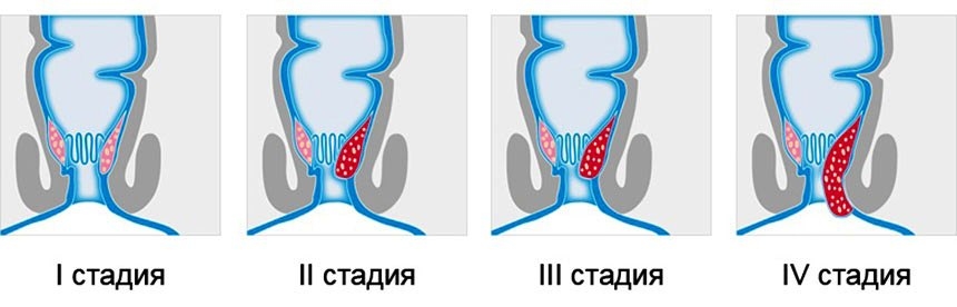 вроджена патологія гемороїдальних вен (розтягнення, звивистість);   підвищена схильність до тромбоутворення (вроджена і набута);   хронічні запори   ;   важкі фізичні навантаження;   вагітність, пологи;   парапроктит;   запалення, тріщини слизової анального каналу;   пухлини печінки   і   пухлини кишечника   ;   анальний секс;   недотримання правил особистої гігієни