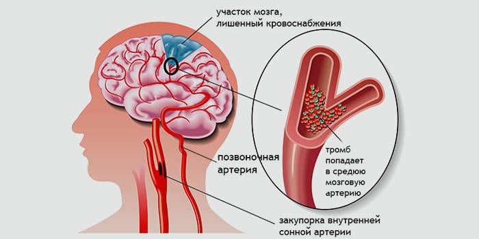 куріння;   неправильне харчування;   захворювання судин і серця;   цукровий діабет;   похилий вік