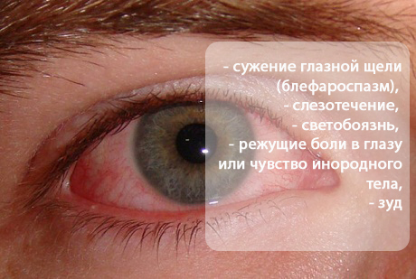 світлобоязнь   біль   сльозотеча   зниження гостроти зору   блефароспазм (не буває тільки при нейротрофических кератитах)   перикорнеальная ін'єкція очного яблука