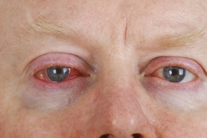 Лікарі офтальмологи розрізняють між двома видами запалення слизової оболонки ока: