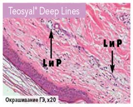 Teosyal® Deep Lines