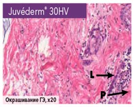 Juvéderm® 30 HV