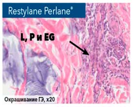 Restylane® Perlane