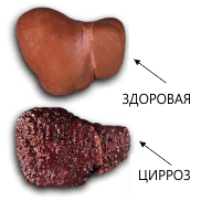 Печінка - це життєво важливий орган, що знаходиться в черевній порожнині під діафрагмою і виконує безліч фізіологічних функцій