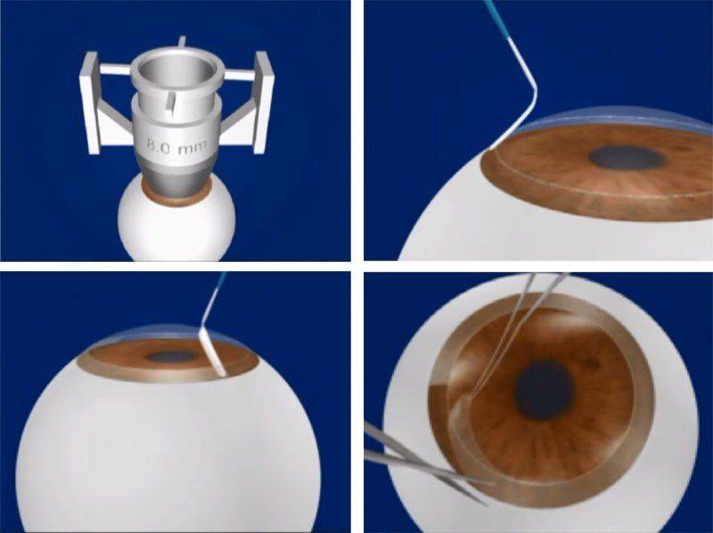 Тільки контактні лінзи надягають поверх кришталика, факічних впроваджуються всередину очного апарату