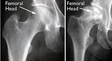 МРТ-знімки можуть показати ознаки раннього остеонекрозу, який поки протікає безсимптомно (наприклад, ознаки остеонекрозу на протилежному суглобі)