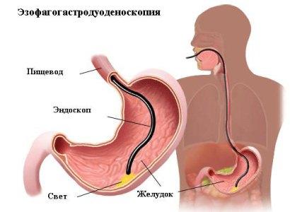 Золотим стандартом діагностики ГЕРХ, втім, як і інших захворювань стравоходу, шлунка і дванадцятипалої кишки, вважається езофагогастродуоденоскопія (ЕФГДС)