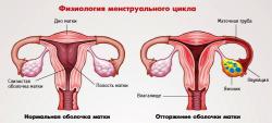 менструація   - це відторгнення слизової оболонки   матки   (Ендометрія), в результаті незапліднені яйцеклітини