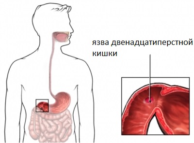 В більшості своїй, виразкова хвороба тонкого кишечника локалізується в місці, іменованому як 12-палої кишки, там, де воротар шлунок з'єднується з тонким кишечником
