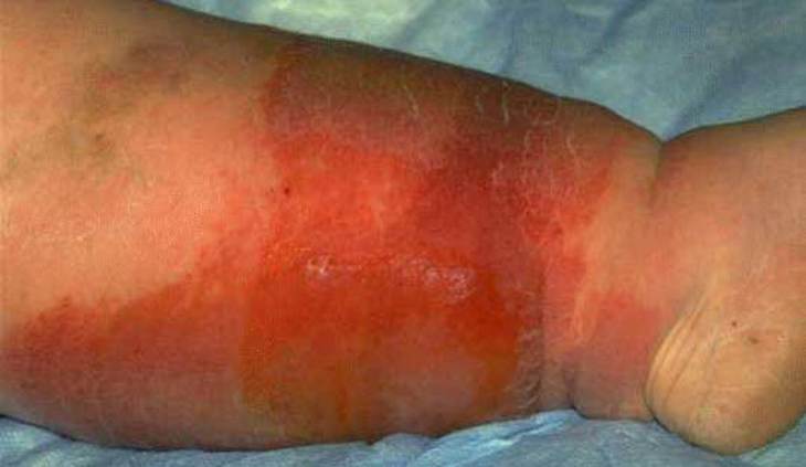 Рожа ̶ інфекційне захворювання із загальною інтоксикацією організму і запальним ураженням шкіри