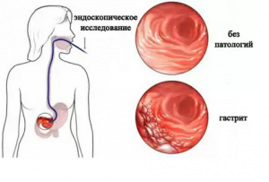 У шлунку може розвиватися запалення двох видів - це гострий і хронічний гастрит