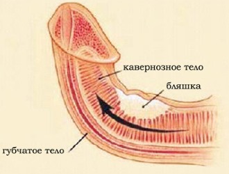 При інфекційних захворюваннях також є тягнуть болі в пенісі, паху і на лобку