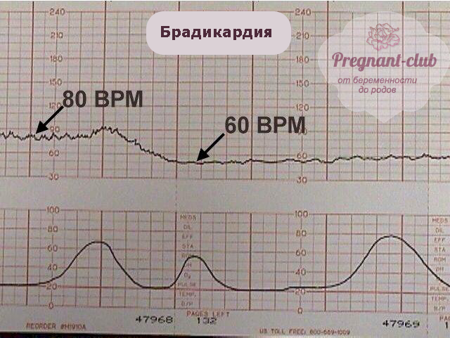 Дане ускладнення є аномально низьку частоту серцебиття плода, яка, як правило, носить тимчасовий характер