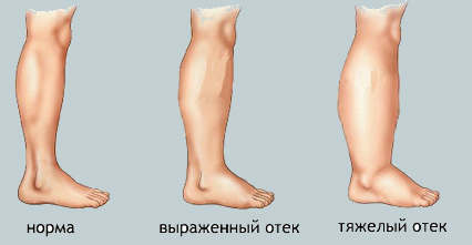 Для хорошого результату потрібно постійно дотримуватися рекомендованого лікарем раціону, а періодичні розвантажувальні дні цей результат закріплять і істотно поліпшать самопочуття майбутньої мами