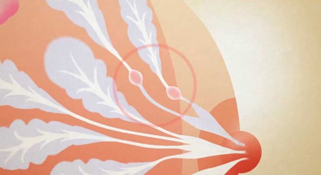 Можливо, збільшення обсягу бюста і больові відчуття можна пояснити утворився в грудях запальним процесом - маститом або лактостазом