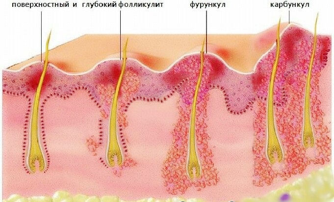 Карбункул представляє собою кілька фурункулів, які об'єднані між собою